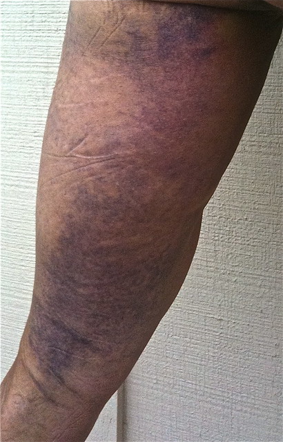 torn-hamstring-avulsion-flickr-photo-sharing