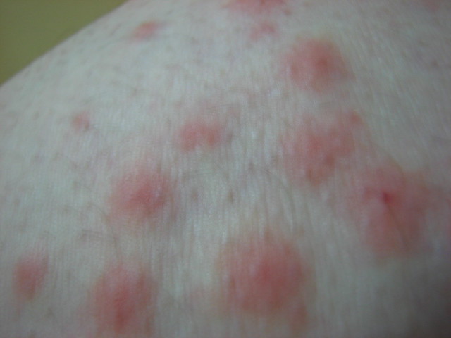 Signs of a bed bug attack | Flickr - Photo Sharing!