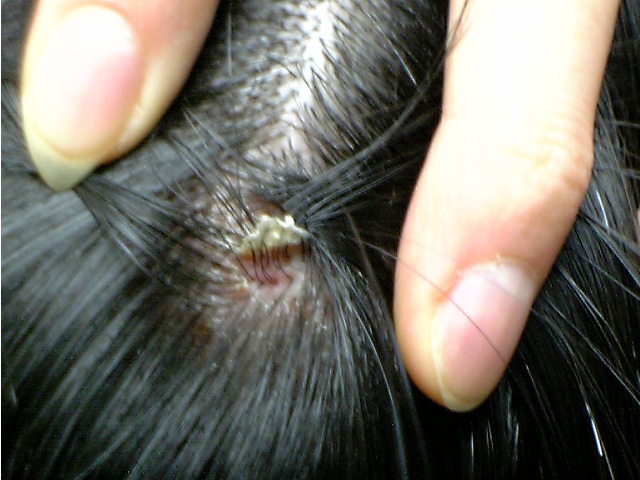Scalp on Scalp Scabs   Flickr   Photo Sharing