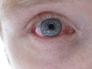 Corneal Transplant for Keratoconus, 11 days post-op - Photo: jACK TWO (CC BY-NC-ND), on Flickr