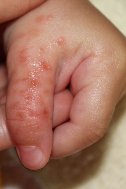 Hand, Foot, And Mouth Disease In Children