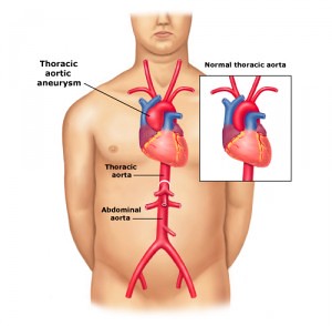 thoracic aortic aneurysm