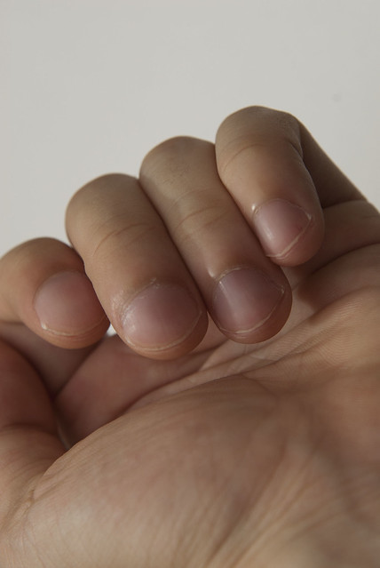 Disease - Nail Clubbing. In medicine, nail clubbing (also known as
