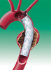 Aortic stenting