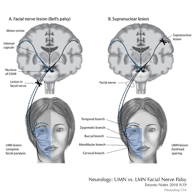 Facial Nerve Lesion 103