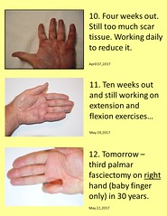 Miscellany: Dupuytren's Contracture