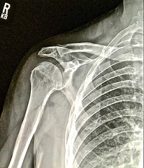 Right Shoulder X-Ray - Pre & Post Processing