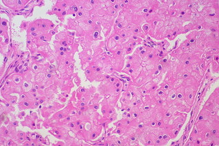 Photo:Chromphobe Renal Cell Carcinoma By:euthman