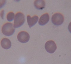 eritrocito corazon en anemia hemolitica