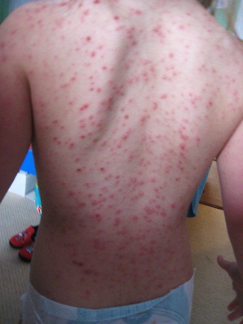 Chickenpox (Varicella) Disease Photos and Images--Educate ...