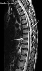 What are clinically significant thoracic VERTEBRAL landmarks? What clues do they give to?