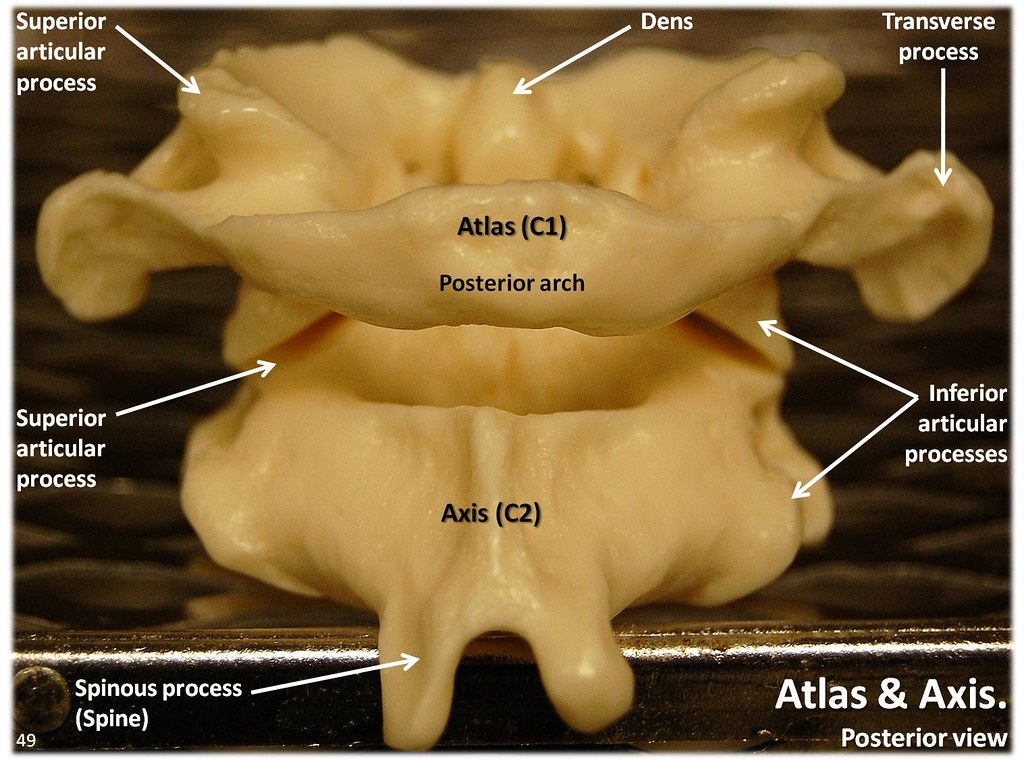 Atlas C1 and Axis C2 vertebrae, posterior view with labels… | Flickr
