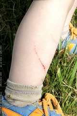 sequoia scratched his leg on a blackberry bush 