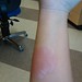 Mosquito allergy