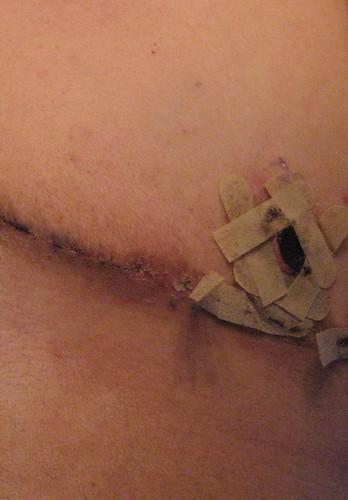 early shot of top surgery scar