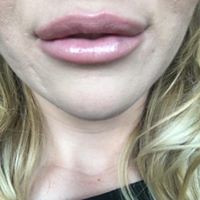 Lips After Example 3