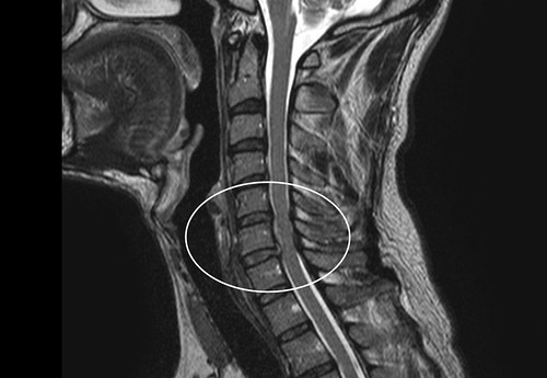頚椎症ヘルニア　首のヘルニア　首のMRI