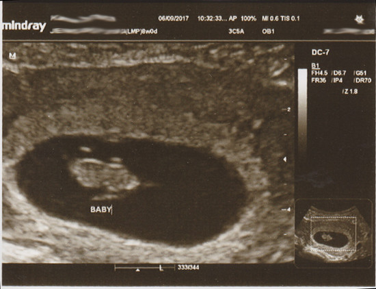 BabyJ5_Ultrasound