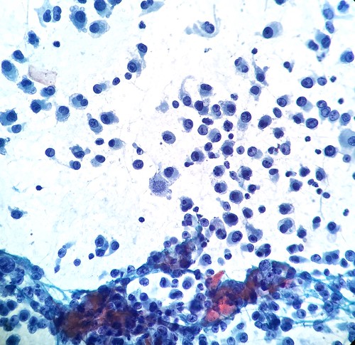 photomicrograph specimen pathology fineneedleaspiration cytology fna hepatic liver metastatic metastasis melanoma