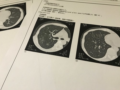 肺のCT検査画像。気管支肺炎。