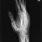 X線写真で見る右手 骨折編