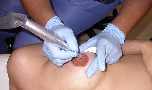 Hospital de Valme nuevo servicio de mircropigmentación mamaria
