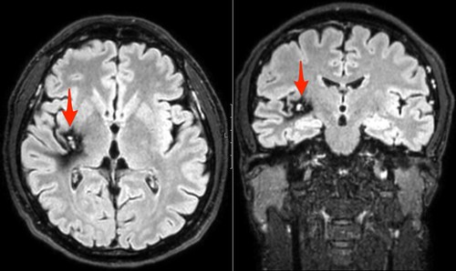 cavernoma