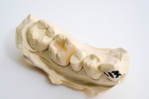缺牙修補不只有全瓷冠 倪志偉醫師：陶瓷鑲嵌體補牙更能保留你的原生牙齒