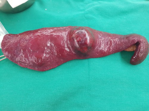 POLO的血管肉瘤2