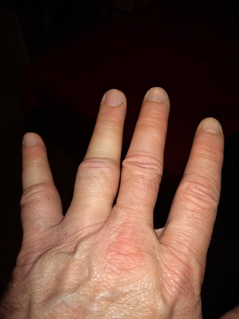 Jammed finger